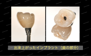 歯型をとり、インプラントの被せ物を作ります